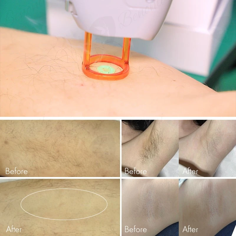 treatment effect